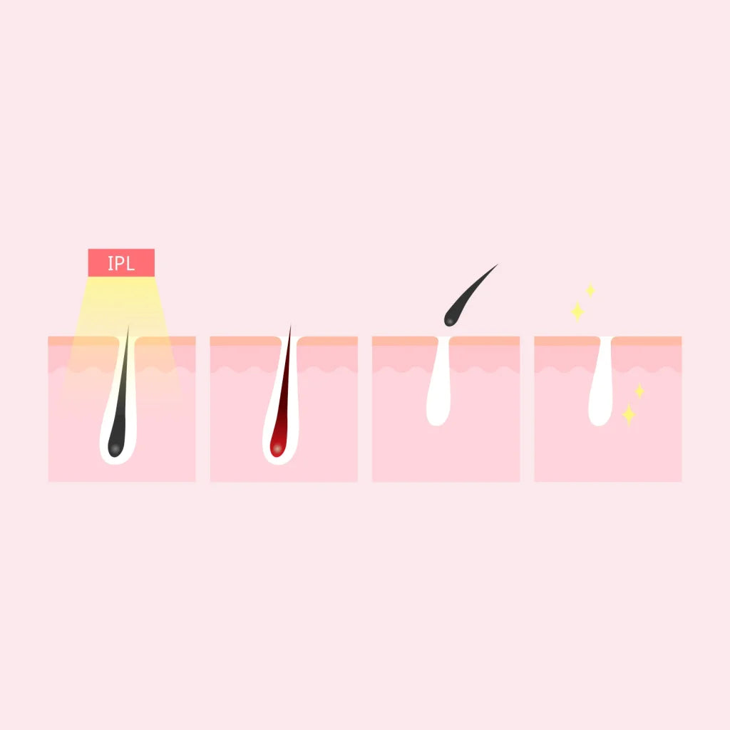 Laser Hair Remover Permanent Epilation System for Face &