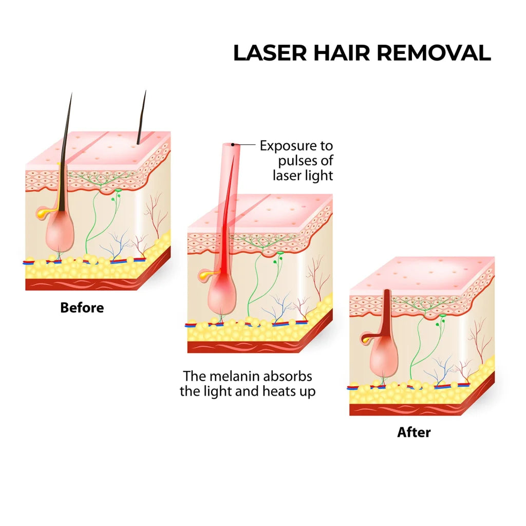 Laser Hair Remover Permanent Epilation System for Face &