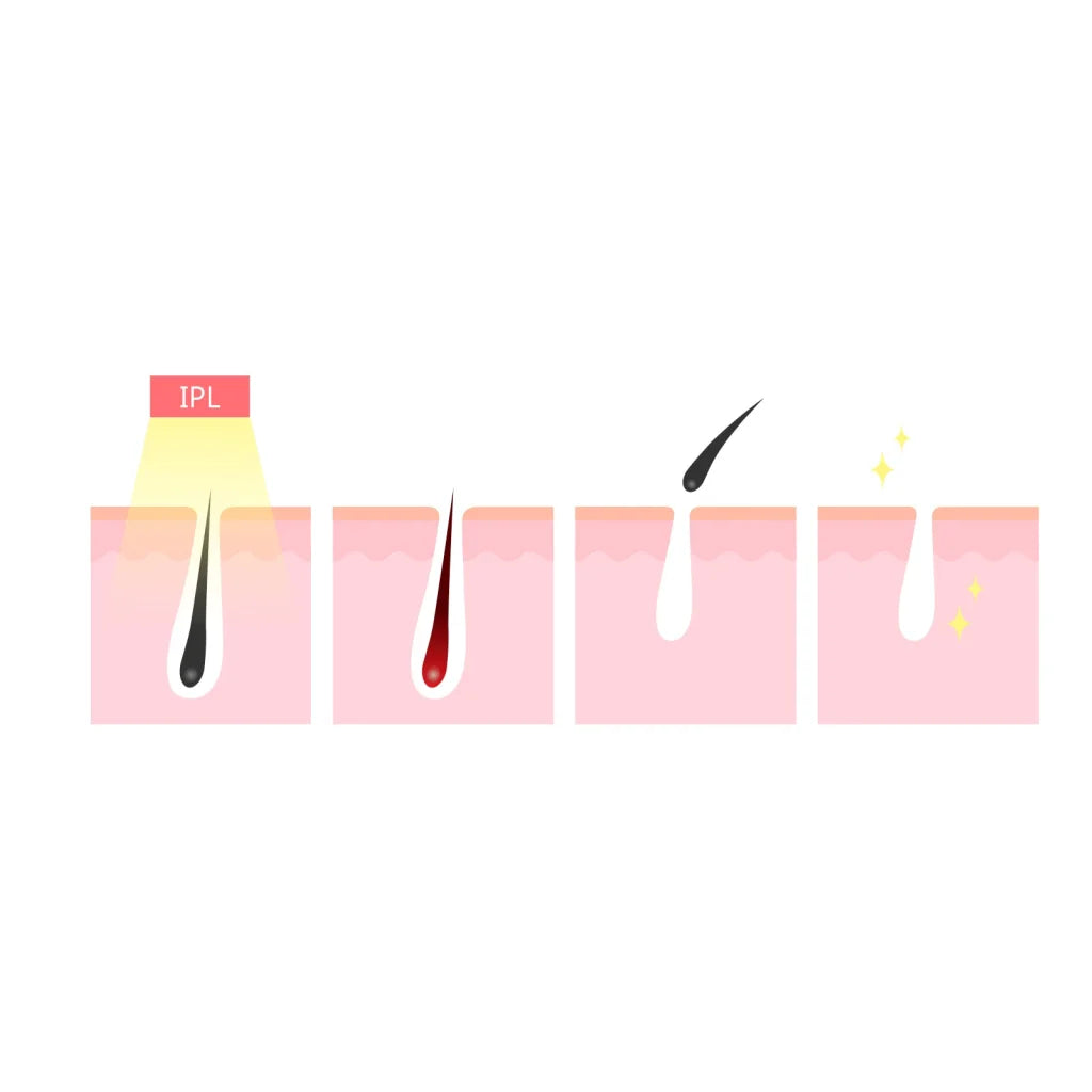 Laser Hair Remover Permanent Epilation System for Face &