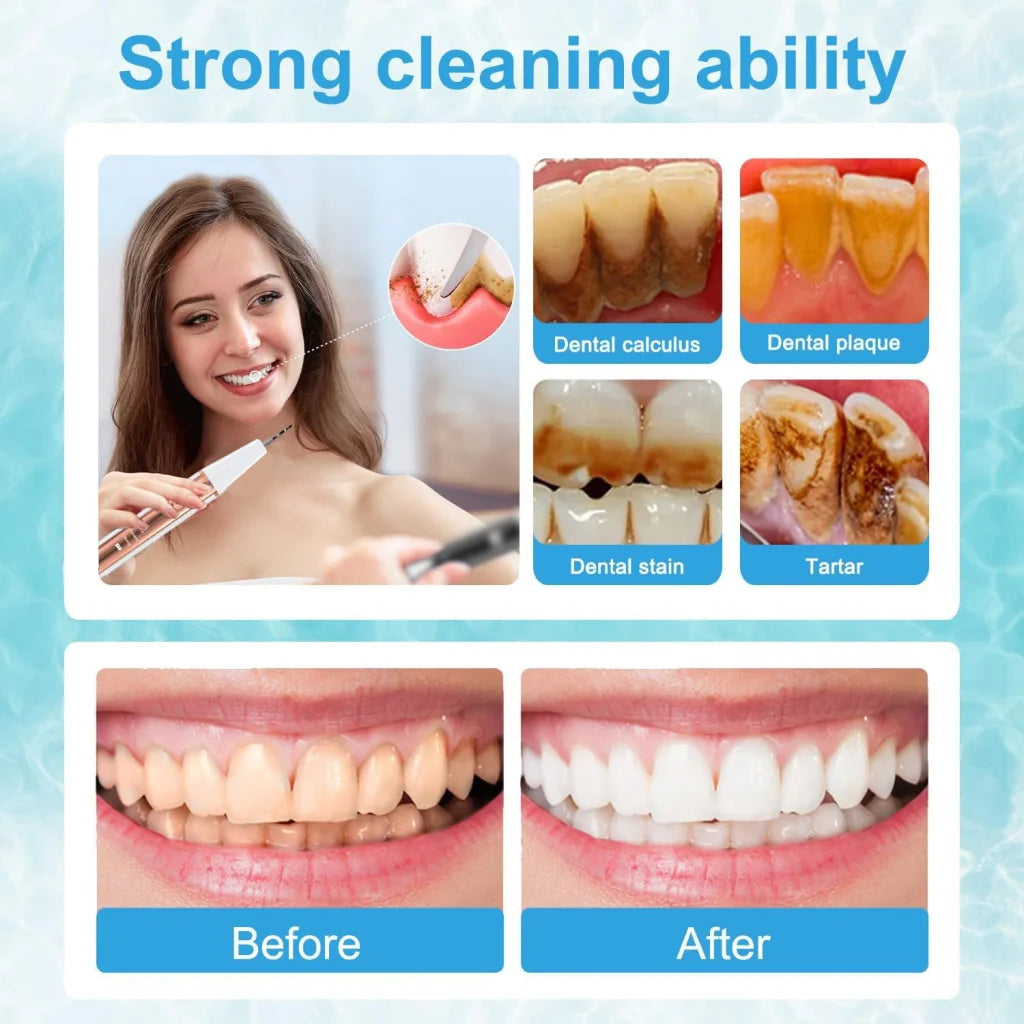 Ultrasonic Dental Scaler Kit - Home Use Teeth Cleaner &
